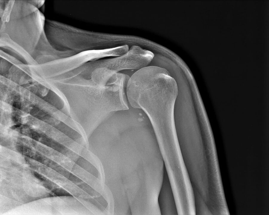 Radiografia dell'artrosi dell'articolazione della spalla del 2° grado di gravità
