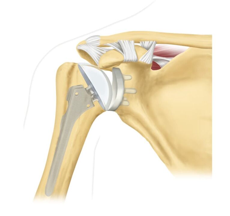 Sostituzione di un'articolazione della spalla danneggiata con un'endoprotesi
