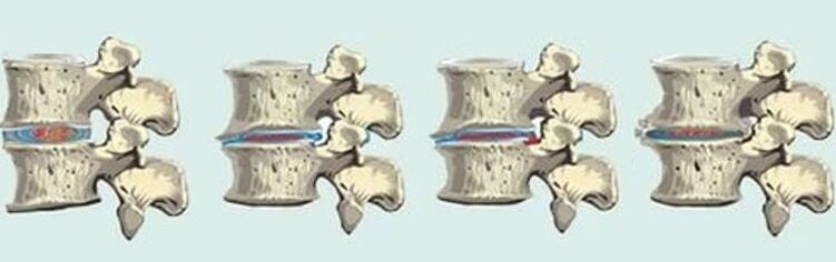 lesione spinale in caso di osteocondrosi toracica