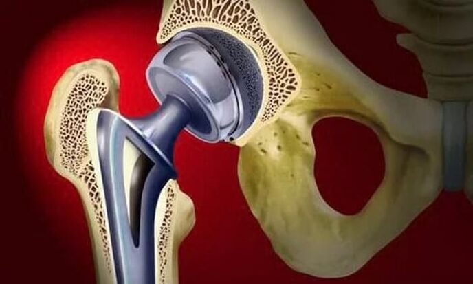 sostituzione dell'articolazione dell'anca per l'artrosi