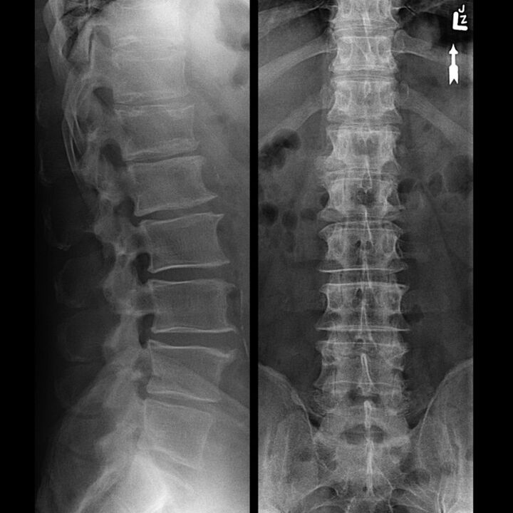 Radiografia della regione toracica, che mostra una diminuzione dello spazio tra le vertebre lungo la colonna vertebrale dal basso verso l'alto