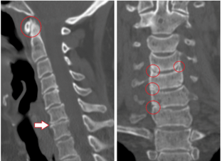 La TC mostra vertebre danneggiate e dischi di altezza eterogenea a causa di osteocondrosi toracica