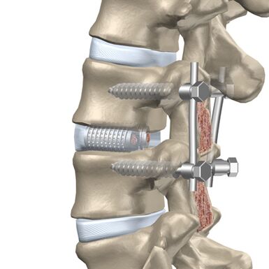 Sostituzione di un disco distrutto della colonna vertebrale toracica con un impianto artificiale