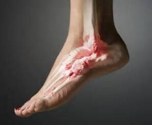 artrosi della caviglia