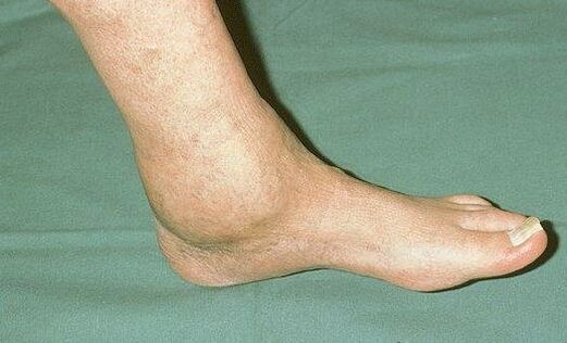 gonfiore della caviglia con artrosi