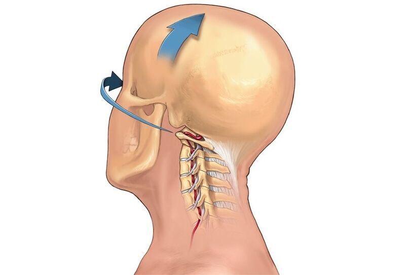 scricchiolio del collo quando si gira la testa come sintomo di osteocondrosi cervicale