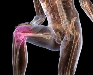 Infiammazione dell'articolazione del ginocchio con artrosi