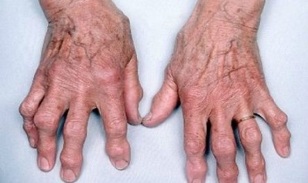 come distinguere l'artrite delle dita dall'artrosi