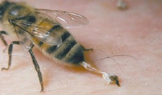 trattamento dell'artrosi dell'anca da parte delle api