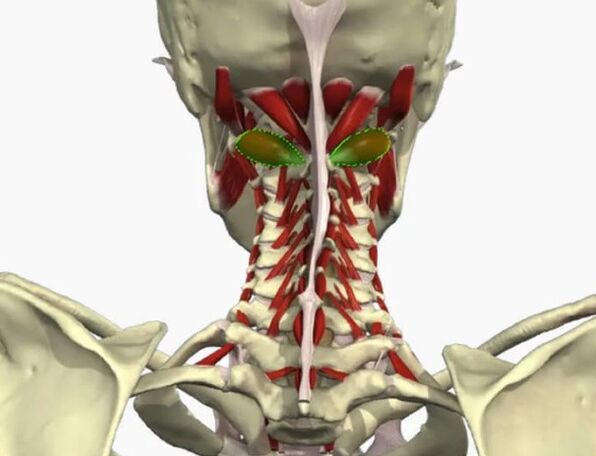 Sindrome dell'arteria vertebrale