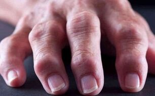 artrite reumatoide come causa di dolori articolari
